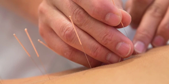 Accupuncture at  Neemtree Ayurveda &amp; Nature Cure
